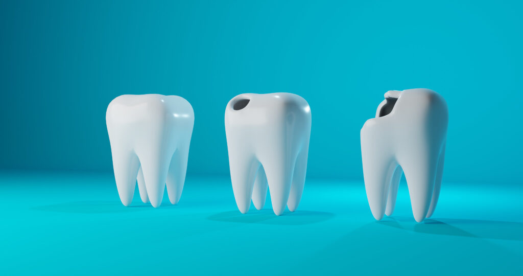 Close-up of three teeth, representing potential side effects of Suboxone and the role of a Suboxone lawyer in related legal claims